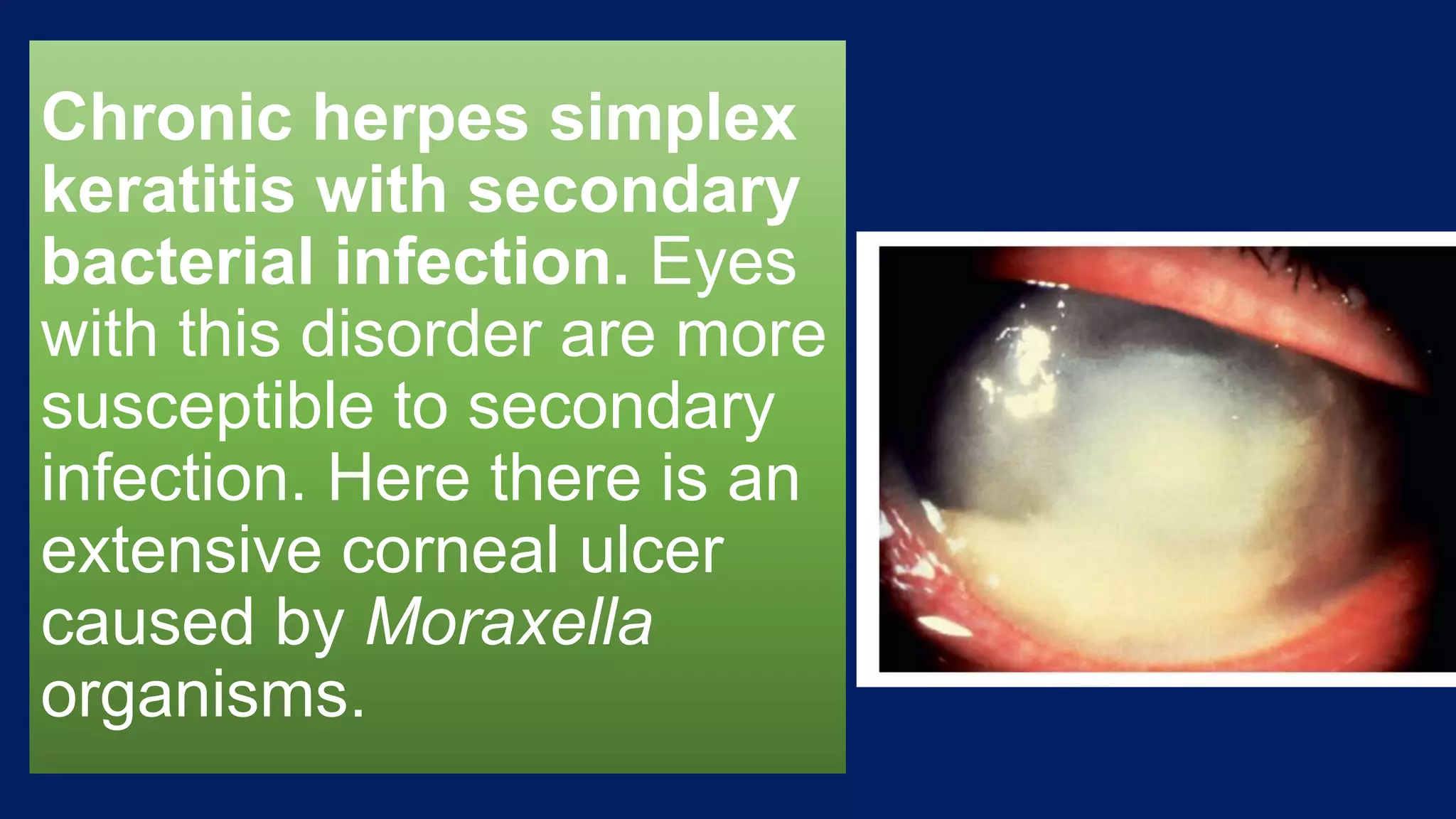Chronic herpes simplex
keratitis with secondary
bacterial infection. Eyes
with this disorder are more
susceptible to secondary
infection. Here there is an
extensive corneal ulcer
caused by Moraxella
organisms.
 
