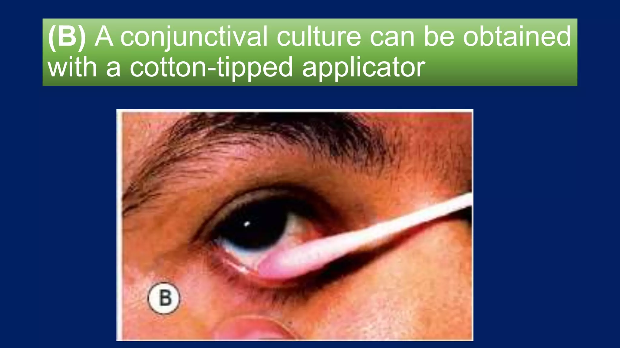 (B) A conjunctival culture can be obtained
with a cotton-tipped applicator
 