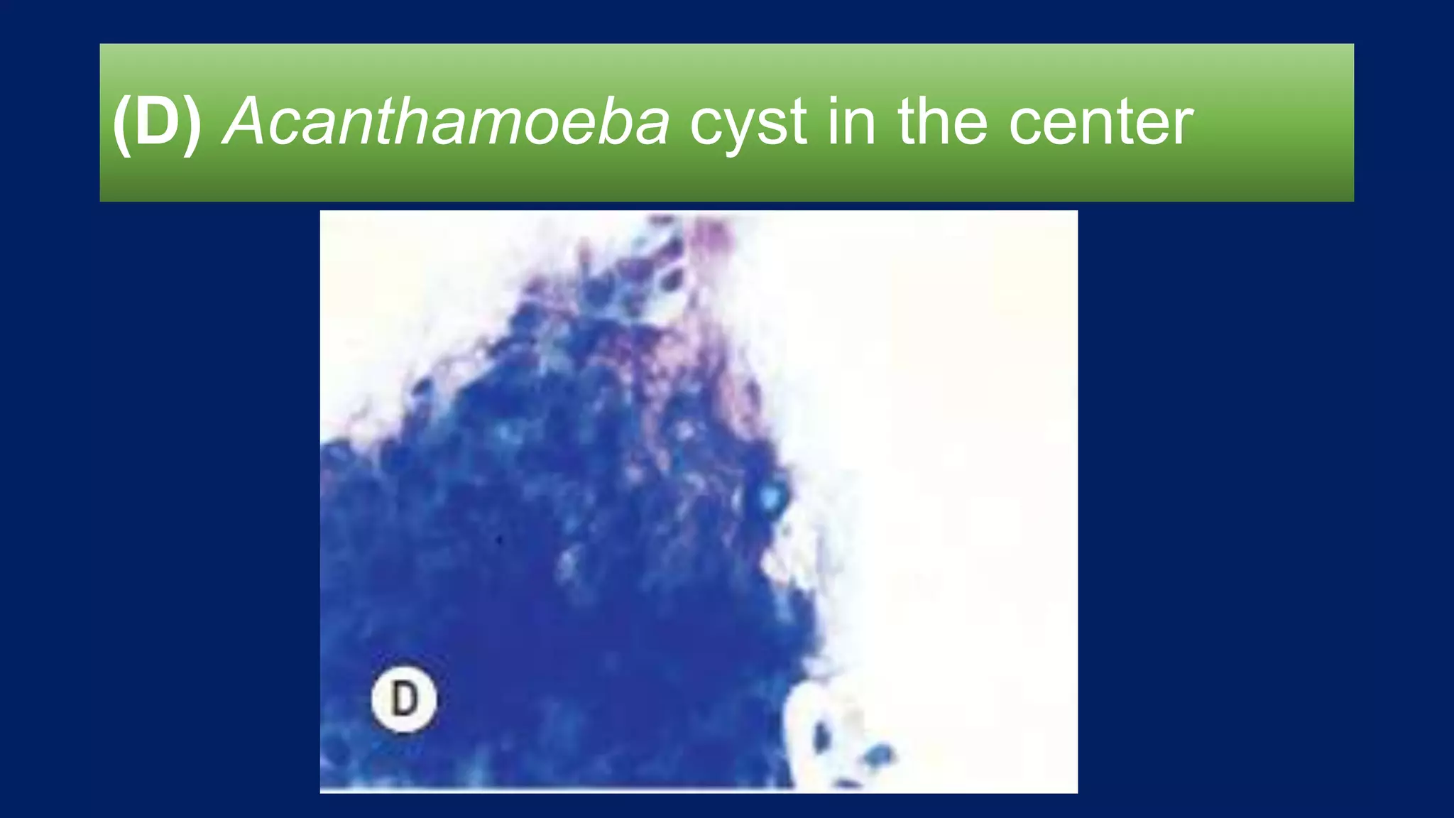 (D) Acanthamoeba cyst in the center
 