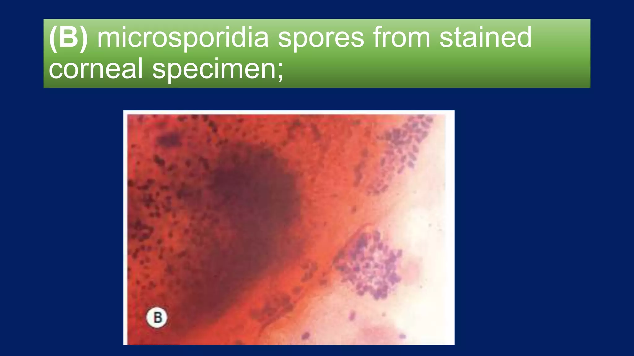 (B) microsporidia spores from stained
corneal specimen;
 