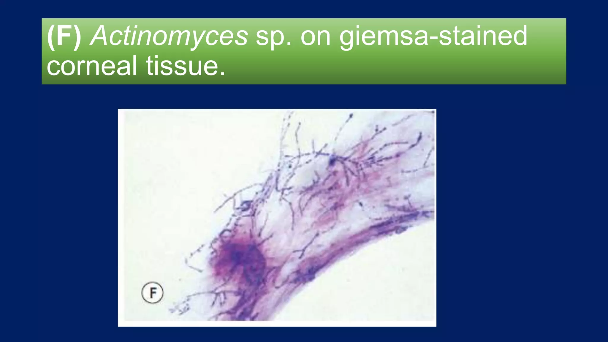 (F) Actinomyces sp. on giemsa-stained
corneal tissue.
 