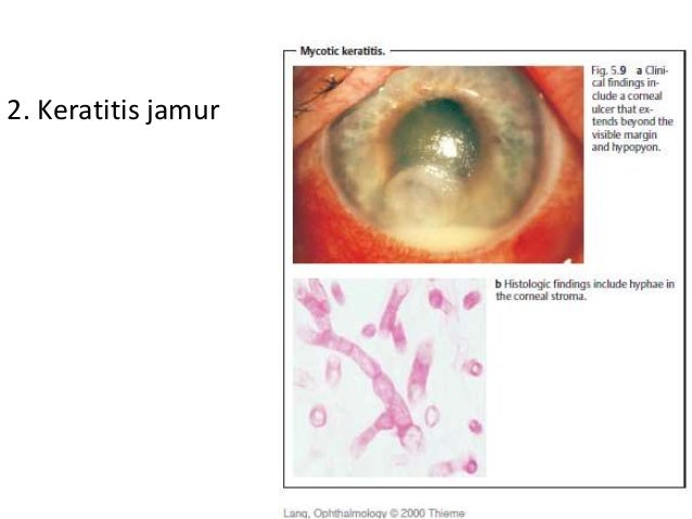Keratitis Mata