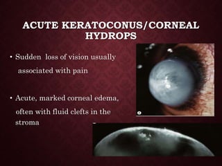 ACUTE KERATOCONUS/CORNEAL
HYDROPS
• Sudden loss of vision usually
associated with pain
• Acute, marked corneal edema,
often with fluid clefts in the
stroma
 
