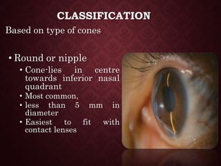 CLASSIFICATION
Based on type of cones
• Round or nipple
• Cone-lies in centre
towards inferior nasal
quadrant
• Most common,
• less than 5 mm in
diameter
• Easiest to fit with
contact lenses
 
