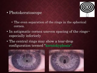 • Photokeratoscope
• The even separation of the rings in the spherical
cornea.
• In astigmatic cornea uneven spacing of the rings--
especially inferiorly
• The central rings may show a tear-drop
configuration termed "keratokyphosis".
 