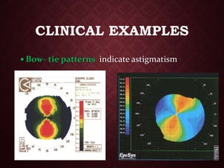 Bow- tie patterns indicate astigmatism
CLINICAL EXAMPLES
 