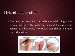 Hybrid lens system
• One way to overcome the problems with piggy-back
lenses, yet have the optics of a rigid lens with the
comfort of a hydrogel, is to fuse a soft rim onto a hard
central portion
 