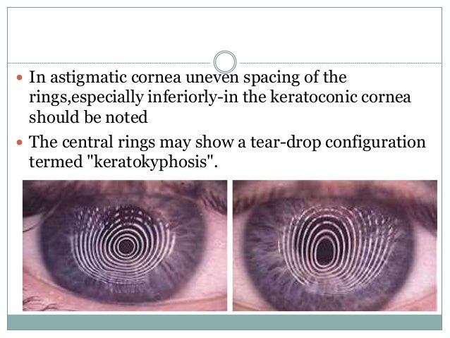 Keratoconus