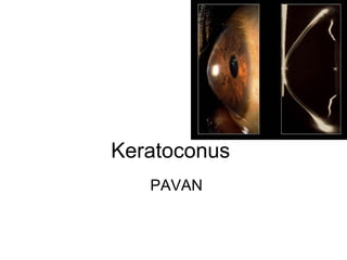 Keratoconus
PAVAN
 