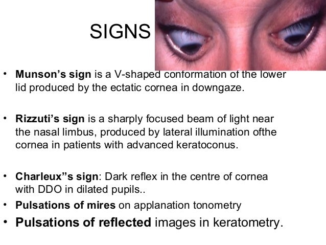 keratoconus 20 638