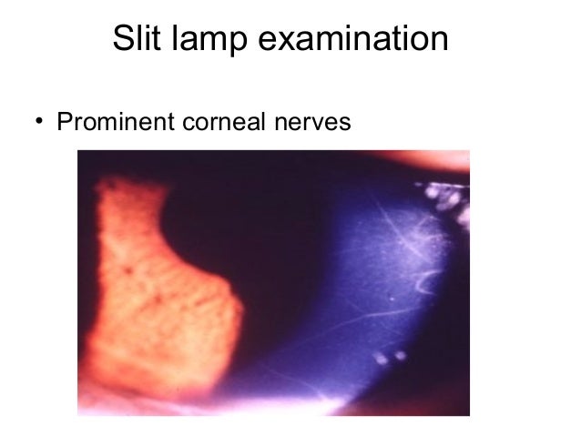 Keratoconus