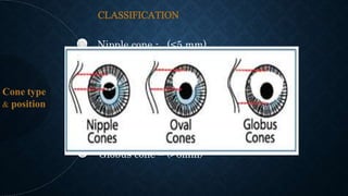 Keratoconus | PPTX
