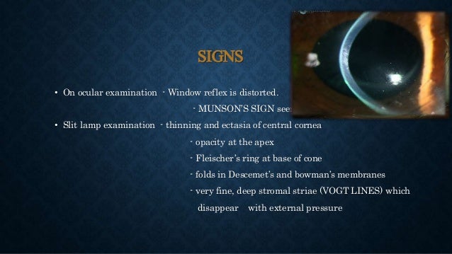 Keratoconus