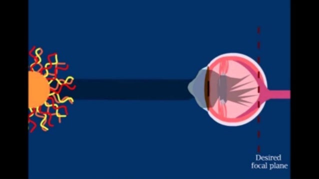 Keratoconus