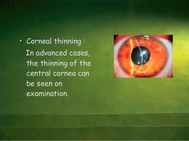 Keratoconus