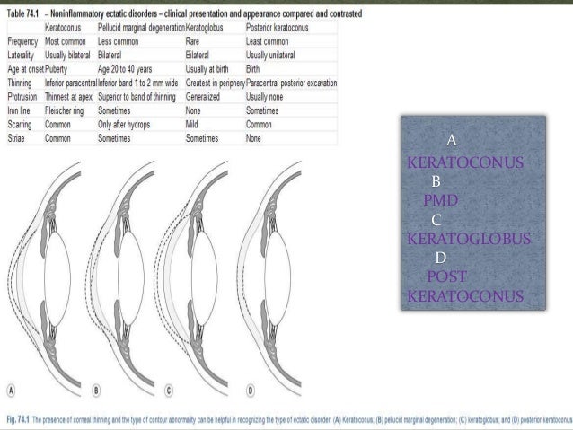 Keratoconus