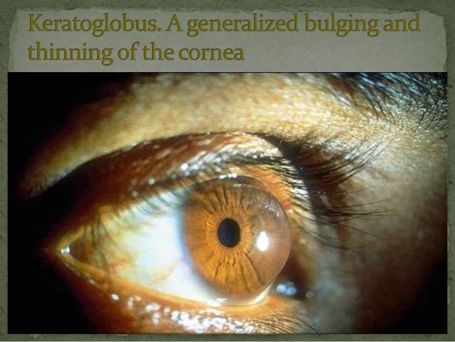 Keratoconus