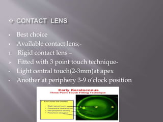  Best choice
 Available contact lens;-
1. Rigid contact lens –
 Fitted with 3 point touch technique-
• Light central touch(2-3mm)at apex
• Another at periphery 3-9 o’clock position
 