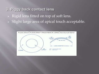  Rigid lens fitted on top of soft lens.
 Slight large area of apical touch acceptable.
 