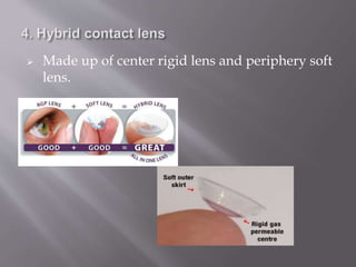  Made up of center rigid lens and periphery soft
lens.
 
