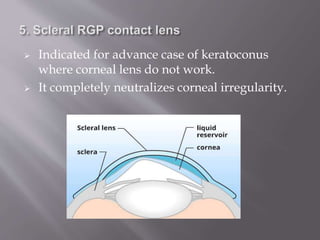  Indicated for advance case of keratoconus
where corneal lens do not work.
 It completely neutralizes corneal irregularity.
 