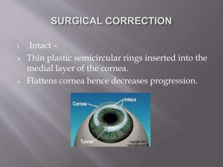 1. Intact –
 Thin plastic semicircular rings inserted into the
medial layer of the cornea.
 Flattens cornea hence decreases progression.
 