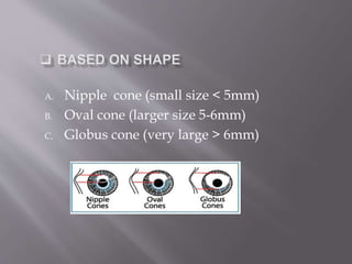 A. Nipple cone (small size < 5mm)
B. Oval cone (larger size 5-6mm)
C. Globus cone (very large > 6mm)
 