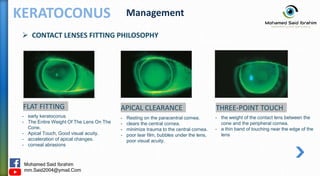 Keratoconus القرنية المخروطية | PPTX
