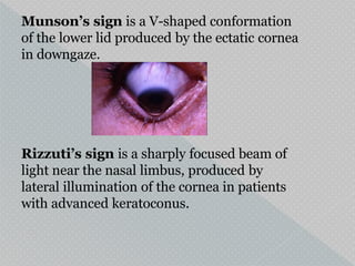 Munson’s sign is a V-shaped conformation
of the lower lid produced by the ectatic cornea
in downgaze.
Rizzuti’s sign is a sharply focused beam of
light near the nasal limbus, produced by
lateral illumination of the cornea in patients
with advanced keratoconus.
 