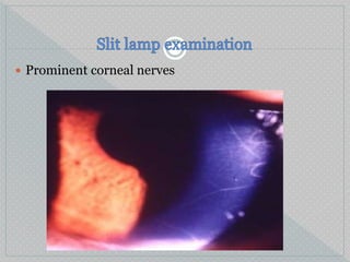  Prominent corneal nerves
 