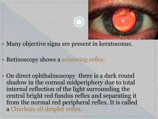  Many objective signs are present in keratoconus.
 Retinoscopy shows a scissoring reflex.
 On direct ophthalmoscopy there is a dark round
shadow in the corneal midperiphery due to total
internal reflection of the light surrounding the
central bright red fundus reflex and separating it
from the normal red peripheral reflex. It is called
a Charleux oil droplet reflex.
 
