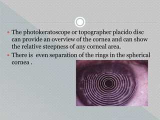  The photokeratoscope or topographer placido disc
can provide an overview of the cornea and can show
the relative steepness of any corneal area.
 There is even separation of the rings in the spherical
cornea .
 