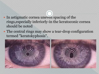  In astigmatic cornea uneven spacing of the
rings,especially inferiorly-in the keratoconic cornea
should be noted
 The central rings may show a tear-drop configuration
termed "keratokyphosis".
 