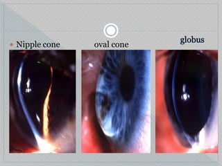  Nipple cone oval cone
 