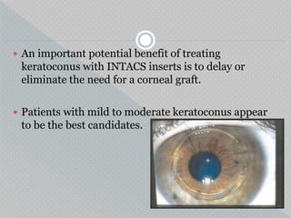  An important potential benefit of treating
keratoconus with INTACS inserts is to delay or
eliminate the need for a corneal graft.
 Patients with mild to moderate keratoconus appear
to be the best candidates.
 