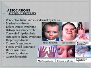  SYSTEMIC DISEASES
 Connective tissue and mesodermal dysplasia
 Marfan’s syndrome
 Ehlers-Danlos syndrome
 Osteogenesis imperfecta
 Congenital hip dysplasia
 Oculodento digital syndrome
 Rieger’s syndrome





Crouzon’s syndrome
Floppy eyelid syndrome
Down syndrome
Turners syndrome
Atopic dermatitis
Atopic dermatitis Down syndrome Ehlers-Danlos
syndrome
Marfan syndrome Crouzon syndrome
Osteogenesis
imperfecta
 