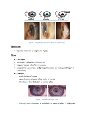 Figure 1 Morphological classification of keratoconus
Symptoms
 Impaired vision due to progressive myopia
Signs
a) Early signs
 “Oil droplet” reflex in ophthalmoscopy
 Irregular “scissor reflex” in retinoscopy
 Mires cannot superimpose and principal meridians are no longer 90° apart in
Keratometry
b) Late signs
 Conical shape of cornea
 Apex of cornea situated below center of cornea
 Placido disc show distortion of corneal reflex
Figure 2 uneven spacing of rings
 Munson’s sign indentation or acute bulge of lower lid, when Pt looks down.
 