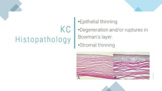 Diagnosis and management of Keratoconus cases