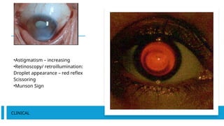 •Astigmatism – increasing
•Retinoscopy/ retroillumination:
Droplet appearance – red reflex
Scissoring
•Munson Sign
CLINICAL
 