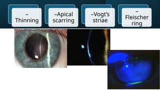 –
Thinning
–Apical
scarring
–Vogt’s
striae
–
Fleischer
ring
 
