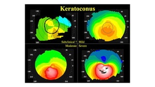 Diagnosis and management of Keratoconus cases