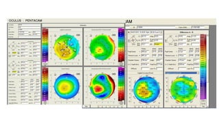 Diagnosis and management of Keratoconus cases