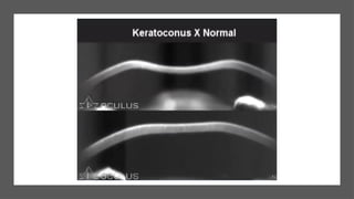 Diagnosis and management of Keratoconus cases