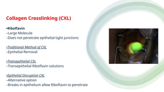 Collagen Crosslinking (CXL)
•Riboflavin
–Large Molecule
–Does not penetrate epithelial tight junctions
•Traditional Method of CXL
–Epithelial Removal
•Transepithelial CXL
–Transepithelial Riboflavin solutions
•Epithelial Disruption CXL
–Alternative option
–Breaks in epithelium allow Riboflavin to penetrate
 