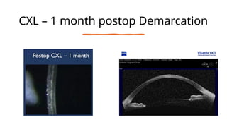 CXL – 1 month postop Demarcation
 