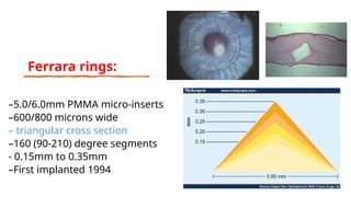–5.0/6.0mm PMMA micro-inserts
–600/800 microns wide
– triangular cross section
–160 (90-210) degree segments
- 0.15mm to 0.35mm
–First implanted 1994
Ferrara rings:
 