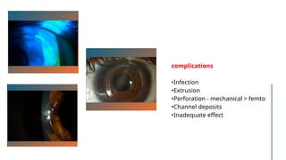 complications
•Infection
•Extrusion
•Perforation - mechanical > femto
•Channel deposits
•Inadequate effect
 