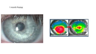 1 month Postop
 