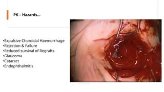 •Expulsive Choroidal Haemorrhage
•Rejection & Failure
•Reduced survival of Regrafts
•Glaucoma
•Cataract
•Endophthalmitis
PK – Hazards…
 