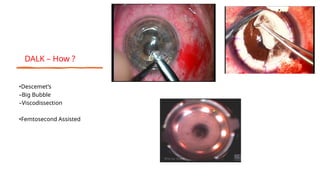 •Descemet’s
–Big Bubble
–Viscodissection
•Femtosecond Assisted
DALK – How ?
 
